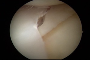 Рис. 2. Артроскопическая картина разрыва мениска.