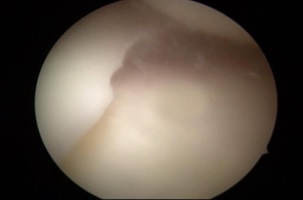 Рис. 3. Артроскопическая картина после резекции поврежденной части мениска.