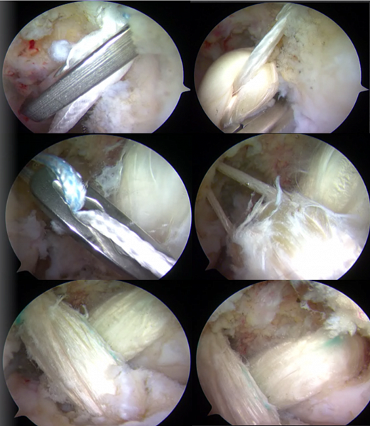 Артроскопические этапы одномоментной пластики ПКС и ЗКС