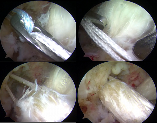 Артроскопическая картина проведения трансплантата ПКС