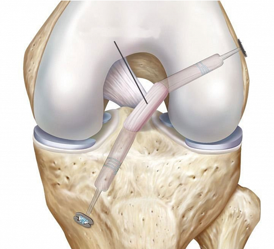 Схема артроскопической пластики ПКС