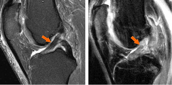 На рисунке – стрелками указаны МРТ-картина нормальной и поврежденной ПКС